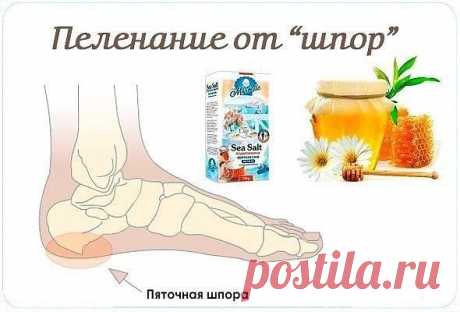 Рецепт, как справиться с пяточными шпорами.