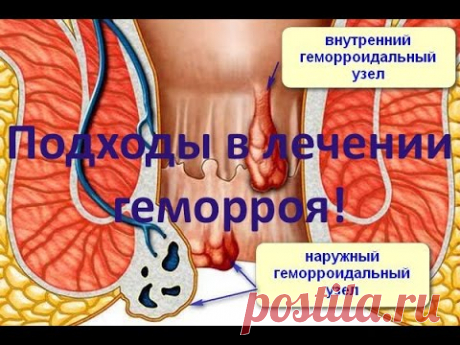 Геморрой - причины, симптомы и лечение