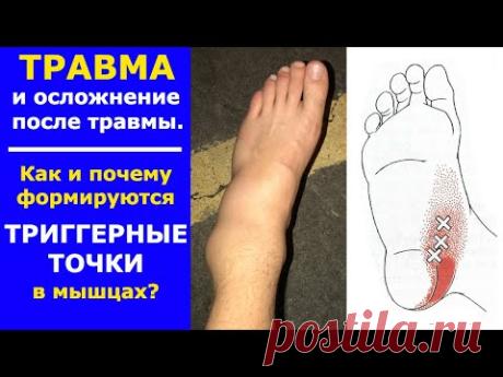 Травма и Триггерные точки. Как появляются триггеры в мышцах? - YouTube