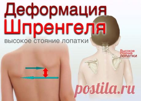 doclvs.ru | Деформация Шпренгеля (врожденное высокое стояние лопатки): причины; симптомы; диагностика; лечение