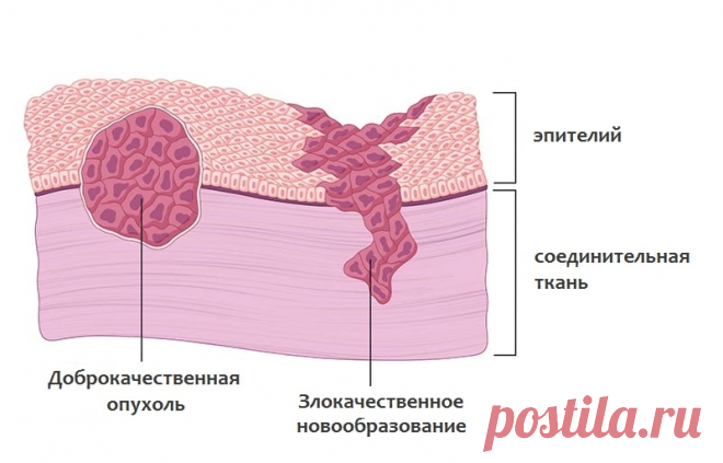 Доброкачественные и злокачественные опухоли: отличия, признаки, виды и характеристики, диагностика новообразований