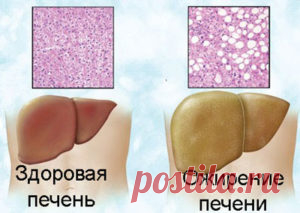 В чем опасность ожирения печени и как его избежать