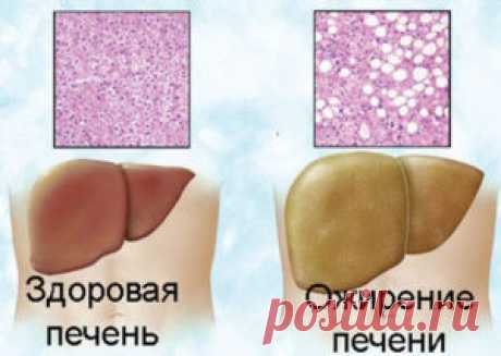 В чем опасность ожирения печени и как его избежать