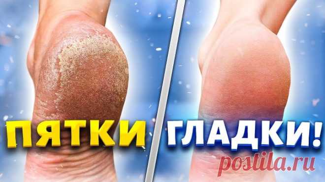ПЯТКИ КАК У МЛАДЕНЦА ЗА 5 МИНУТ. Убрать - натоптыши, сухие мозоли, трещины на пятках!