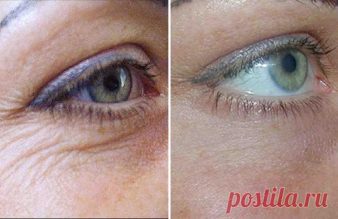 Самый эффективный домашний крем от морщин вокруг глаз! - Советы и Рецепты Ингредиенты этого домашнего крема от морщин полностью натуральны. Применение этого крема помогает эффективно разглаживать морщины, а также предупреждать появление новых морщин и мешков под глазами. Кожа вокруг глаз — очень тонкая, и именно на ней мы замечаем первые признаки неудержимого и безжалостного течения времени. Область кожи вокруг глаз страдает не только от эффекта времени, но …