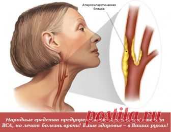 Преходящее нарушение мозгового кровообращения. Симптомы