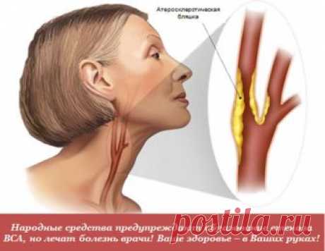 Преходящее нарушение мозгового кровообращения. Симптомы