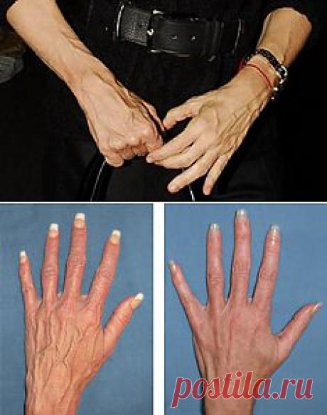 (+1) тема - Вены на руках | ВСЕГДА В ФОРМЕ!