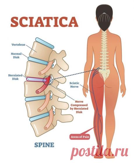 Лечебные позы при ишиалгии и боли в спине / Будьте здоровы