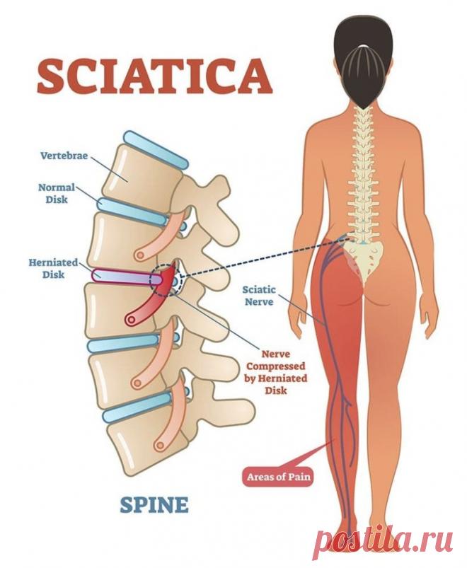 Лечебные позы при ишиалгии и боли в спине / Будьте здоровы