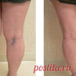 Природные средства лечения варикозного расширения вен