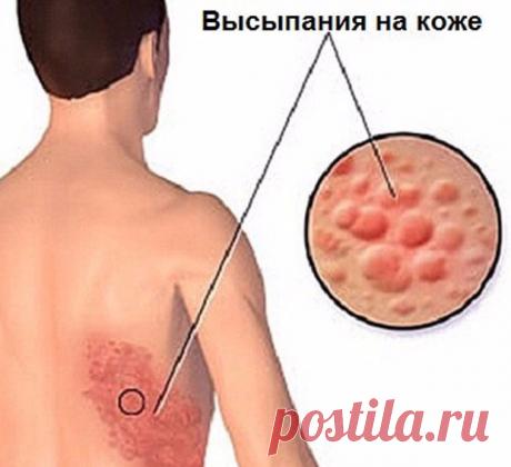 Опоясывающий лишай: лечение натуральными средствами Вирус попадает в организм и «засыпает», и однажды сложившиеся определенным образом условия вынуждают его выйти на поверхность.