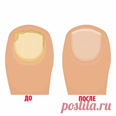 Как быстро избавиться от грибка ногтей / Будьте здоровы