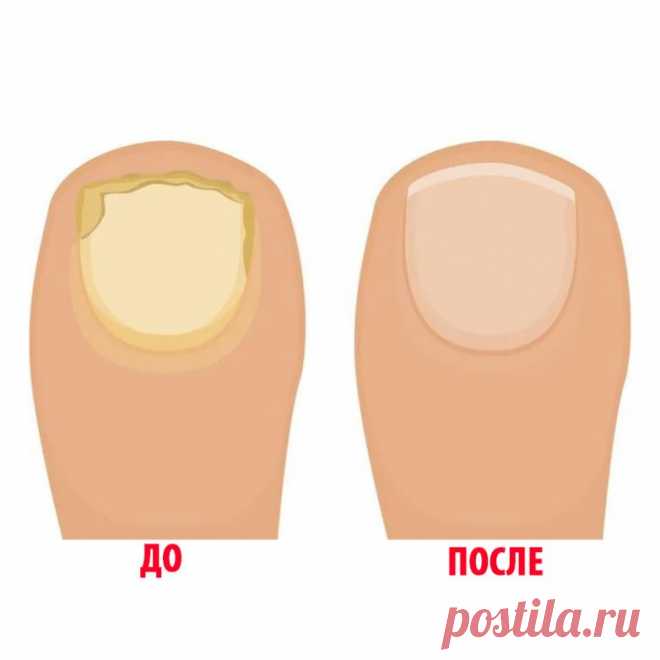 Как быстро избавиться от грибка ногтей / Будьте здоровы