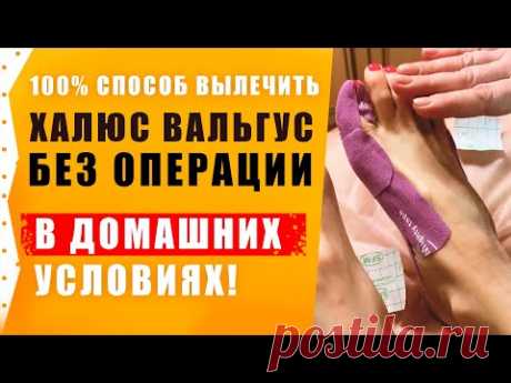 Халюс Вальгус – Лечение без операции в домашних условиях ! Подагра.