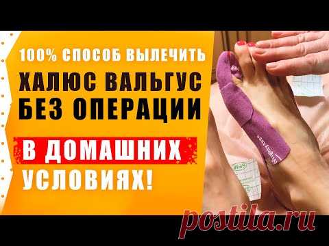 Халюс Вальгус – Лечение без операции в домашних условиях ! Подагра.