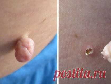 5 способов избавления от папиллом в домашних условиях: что-то вам точно поможет (советы по применению) - HeadInsider