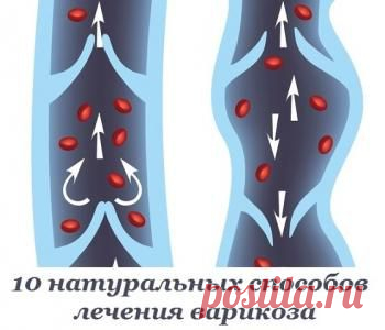 10 натуральных способов лечения варикоза