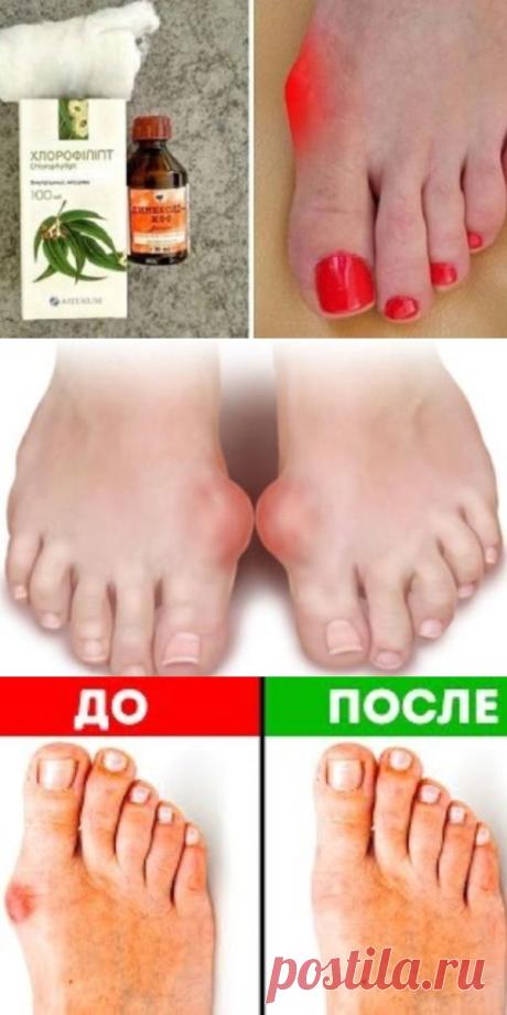 Косточка больше не болит! Потратила мелкие деньги на 2 средства, эффект невероятен