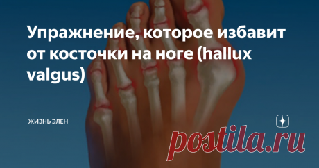 Упражнение, которое избавит от косточки на ноге (hallux valgus) Вальгусная деформация первого пальца стопы или hallux valgus.
Многим людям омрачает радость жизни косточка на ноге. А как трудно бывает подобрать удобную обувь, которая бы минимизировала дискомфорт. Ладно бы если бы дело было только в эстетике