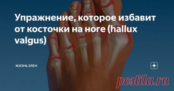 Упражнение, которое избавит от косточки на ноге (hallux valgus) Вальгусная деформация первого пальца стопы или hallux valgus.
Многим людям омрачает радость жизни косточка на ноге. А как трудно бывает подобрать удобную обувь, которая бы минимизировала дискомфорт. Ладно бы если бы дело было только в эстетике