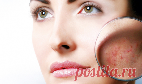 ДОМАШНЯЯ МИКРОДЕРМОАБРАЗИЯ: УДАЛЯЕТ ПЯТНА, МОРЩИНЫ, ШРАМЫ И ПРЫЩИ ПОСЛЕ ПЕРВОГО ИСПОЛЬЗОВАНИЯ! | Всегда в форме!