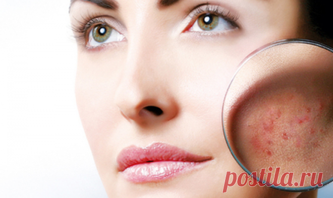 ДОМАШНЯЯ МИКРОДЕРМОАБРАЗИЯ: УДАЛЯЕТ ПЯТНА, МОРЩИНЫ, ШРАМЫ И ПРЫЩИ ПОСЛЕ ПЕРВОГО ИСПОЛЬЗОВАНИЯ! | Всегда в форме!