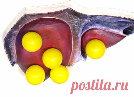 Жировая болезнь (дистрофия) печени. Кому грозит цирроз