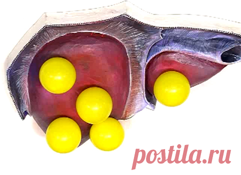 Жировая болезнь (дистрофия) печени. Кому грозит цирроз