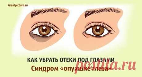 Как убрать отеки под глазами. Синдром «опухшие глаза».