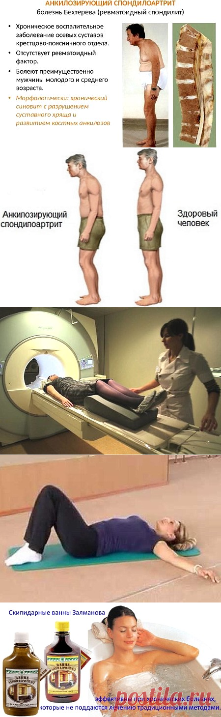 анкилозирующий спондилоартрит клинические рекомендации 2017