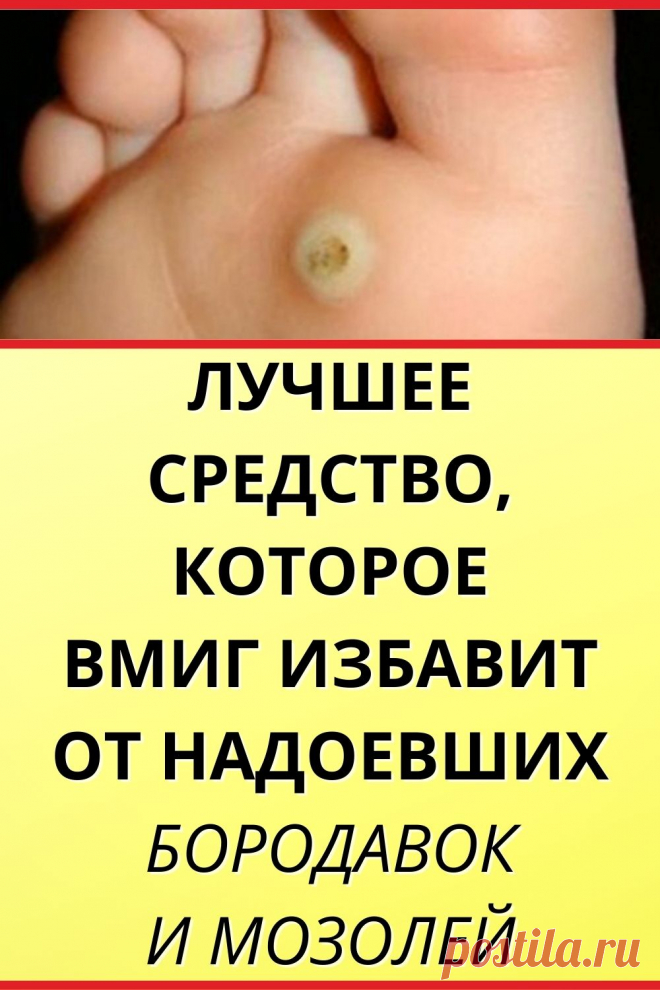 Лучшее средство, которое вмиг избавит от надоевших бородавок и мозолей