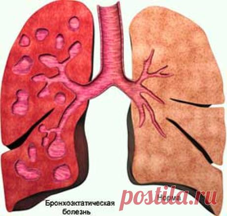 Бронхоэктатическая болезнь - описание болезни