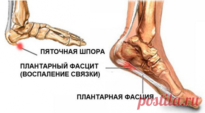 Реальная история лечения пяточной шпоры