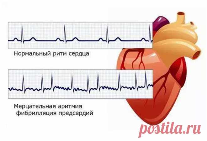 Как жить с постоянной формой мерцательной аритмии. Случай из практики. | Кардиолог Константин Крулёв | Дзен