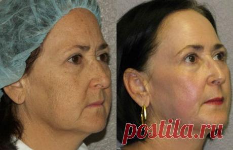 Гликолевый пилинг: для лица, виды, поверхностный, срединный, глубокий, показания, противопоказания, отзывы и результаты, фото до и после, цена, беременность, можно ли летом, уход, химический, что это такое, где купить, 10, 30, 50, 70