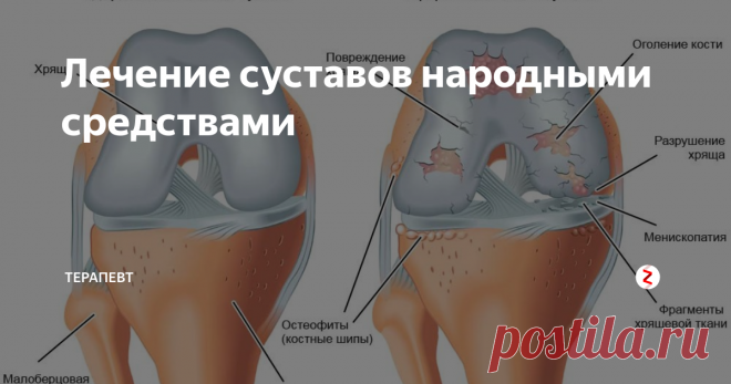 Лечение суставов народными средствами Особенно  часто напоминают о себе суставы хрустом, малоподвижностью и болью. К  процессу лечения всегда ...
