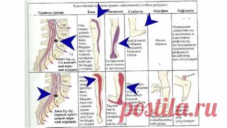 Чудо точка, которая избавит от боли в ягодице, ногах и пояснице