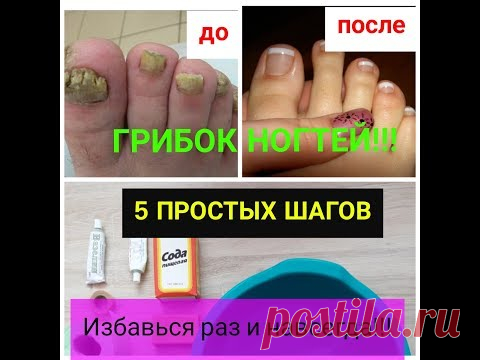Дерматолог: ИЗБАВЬТЕСЬ ОТ ГРИБКА НОГТЕЙ РАЗ И НАВСЕГДА с помощью 5 простых правил