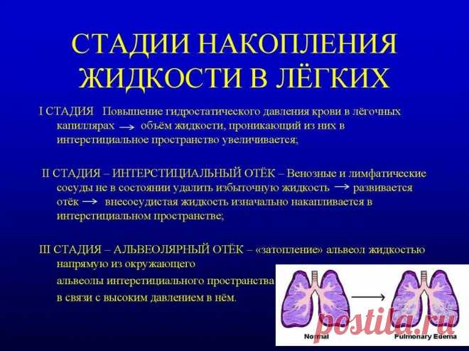 жидкость в плевре легких причины и лечение: 2 тыс изображений найдено в Яндекс Картинках