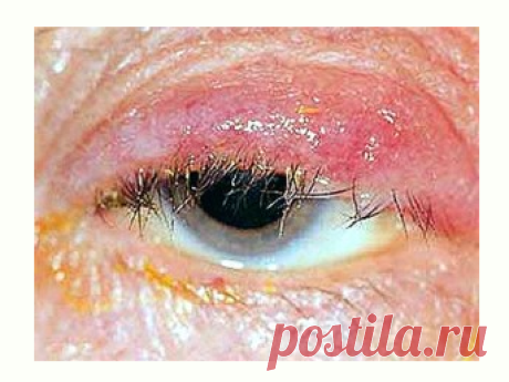 Ophthalmia