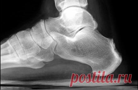 Гетерогенная группа воспалительных ревматических заболеваний с преимущественным вовлечением осевых и периферических суставов и энтезитов (воспаление на месте соединения сухожилий и связок к кости). Они также имеют другие функции, такие как передний увеит и поражения кишечника, сходного с болезнью Крона. Симптомы в пределах определенных причин могут пересекаться и могут переходить от одного к другому. Существует высокая частота встречаемости НLA-B27, но отрицательные анализы на ревматоидный факто