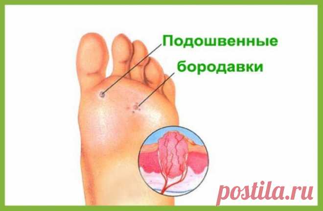Удалить родинки, черные угри, бородавки, папилломы и пигментные пятна можно естественно и быстро! | Deewan