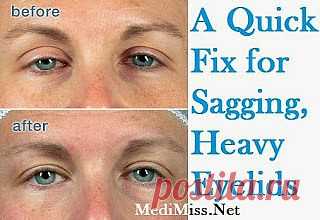 Quick Fix для провисание, тяжелые веки ~ MediMiss