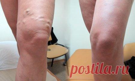 Цей рецепт допоможе позбутися від варикозу і судинної сітки всього за 30 хвилин…