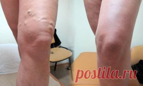 Цей рецепт допоможе позбутися від варикозу і судинної сітки всього за 30 хвилин…