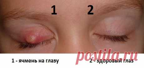 КАК ЛЕЧИТЬ ЯЧМЕНЬ НА ГЛАЗУ ? — Копилочка полезных советов