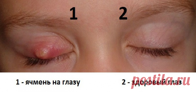 КАК ЛЕЧИТЬ ЯЧМЕНЬ НА ГЛАЗУ ? — Копилочка полезных советов