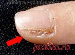 Лечение грибок ногтей лазером в уфе - О грибке ногтей Пенсионеры! Не стригите грибковые ногти! Они выводятся просто: возьмите 9 гр... Военврач: Чтобы у солдат...