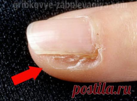 Лечение грибок ногтей лазером в уфе - О грибке ногтей Пенсионеры! Не стригите грибковые ногти! Они выводятся просто: возьмите 9 гр... Военврач: Чтобы у солдат...